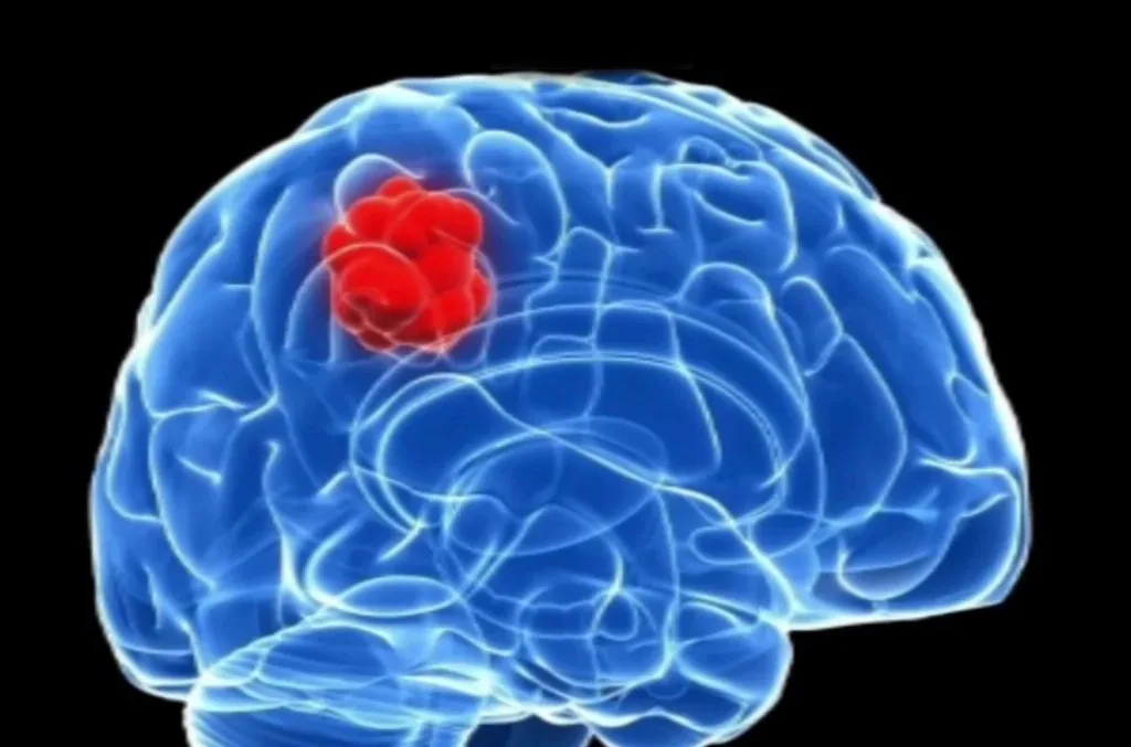 Reconocen la importancia de consultar por cambios neurológicos ante posible tumor cerebral
